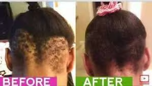 Decreased hair thickness