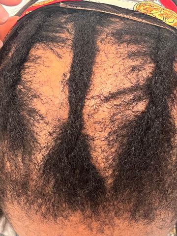 Androgenic Alopecia Example