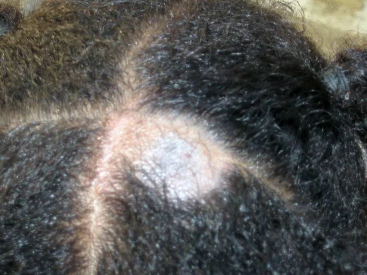 Alopecia Areata Example