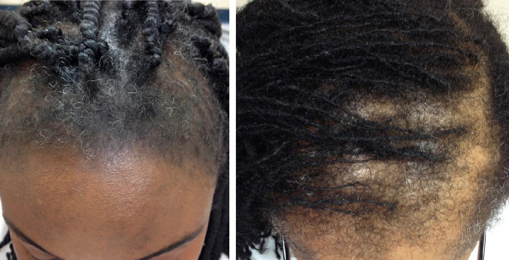 Traction Alopecia Example