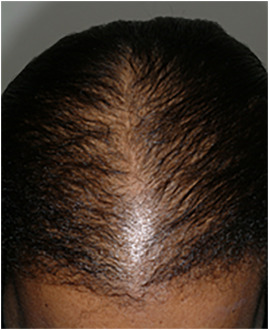 Nutritional Deficiency Hair Loss Example