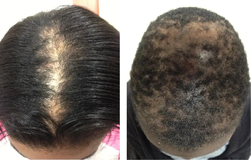 Cicatricial Alopecia Example