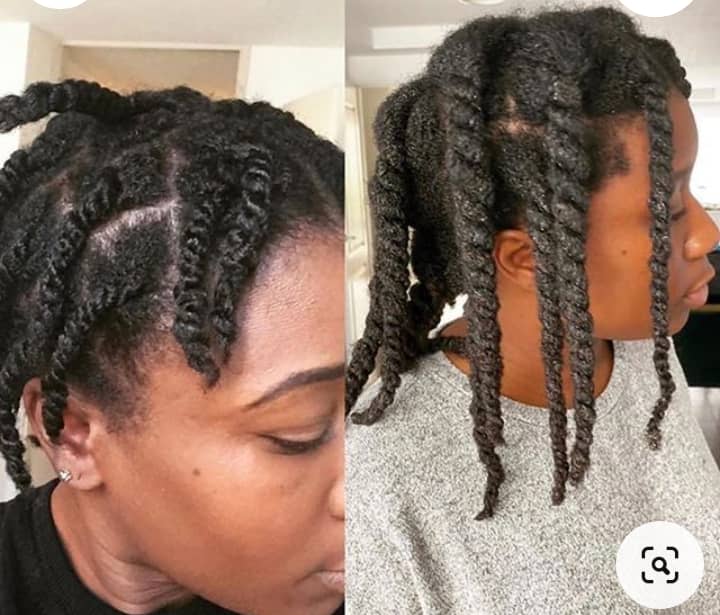 Traction Alopecia